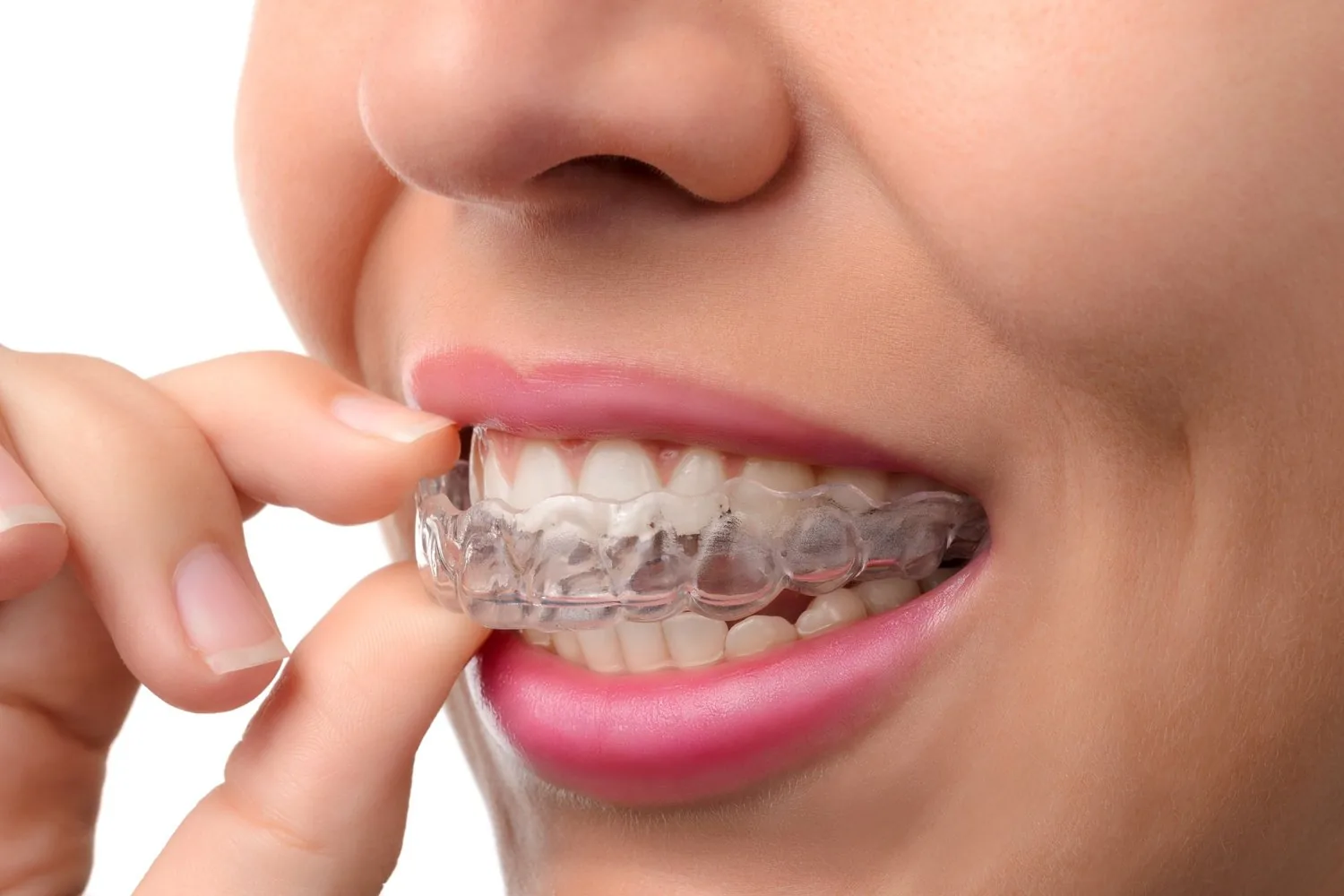A person placing a clear aligner tray onto their upper teeth.